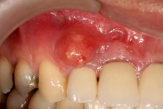 Diş Eti ve Periodontal Abseli bir ağız