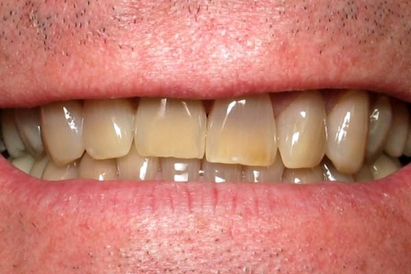 Diş BeyazlatmaBleaching Diş Eti Doktoru Bloğu